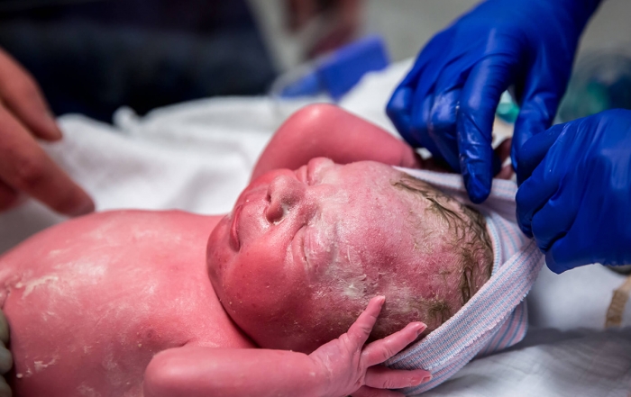 De baby is met een keizersnede in het ziekenhuis in Alkmaar geboren