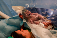 Keizersnede-Hoorn-16 De baby wordt gelijk na de keizersnede aan de mama getoond