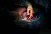 Het hoofdje is zichtbaar tijdens de keizersnede in het RKZ in Beverwijk