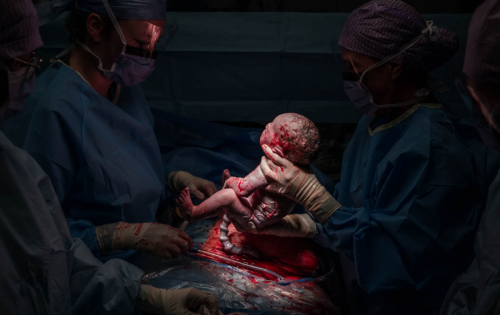 De baby wordt via geplande keizersnede geboren in RKZ Beverwijk
