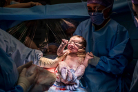 De baby wordt geboren middels een keizersnede in het ziekenhuis in Beverwijk